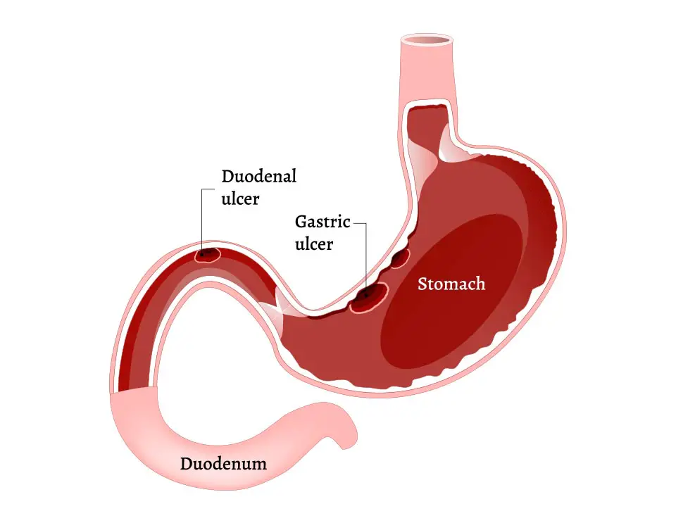 Gastric Ulcer Vs Duodenal Ulcer