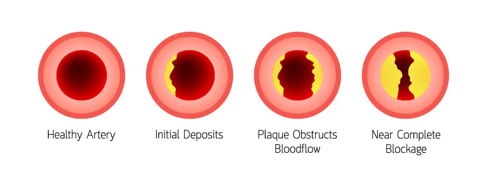 Arteries clogging evolution